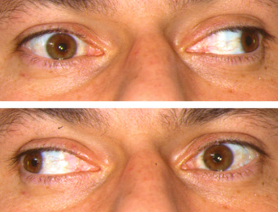 Paralysies Oculaires